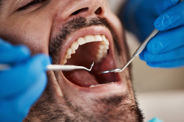 Best Emergency Dental Care for Broken or Chipped Teeth in Beavercreek, OH